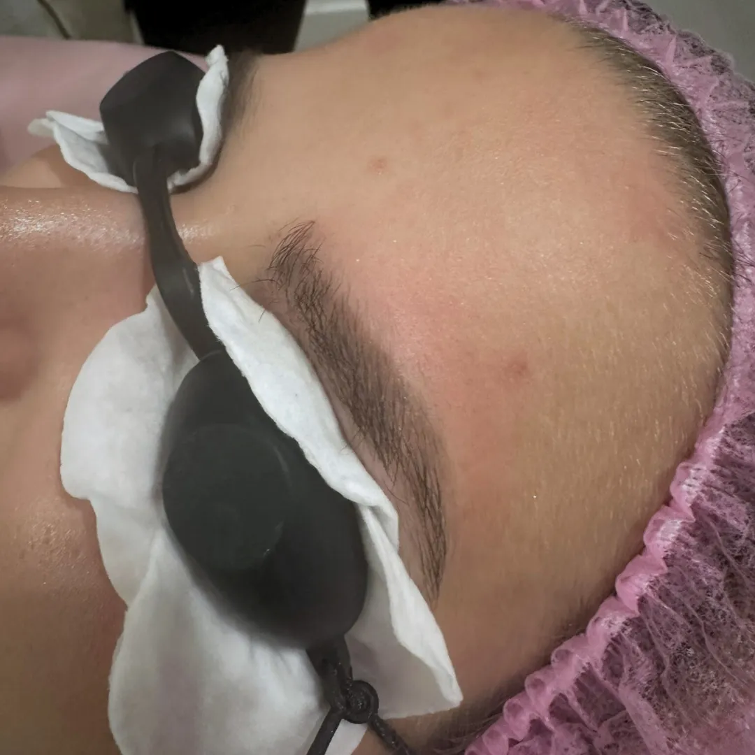 Zabieg laserowy – po